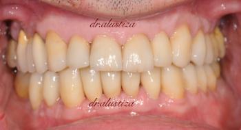 clinica dental alustiza bilbao carillas despues