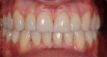 clinica dental alustiza reparación dental