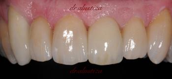 clinica dental alustiza bilbao cambio coronas