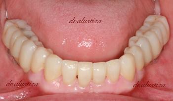 clinica dental alustiza bilbao implantes dentales despues