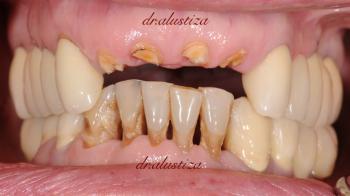 clinica dental bilbao alustiza traumatismo