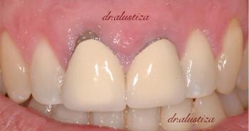 clinica dental alustiza bilbao implantes dentales atornillados