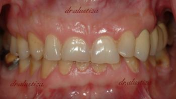 clinica dental alustiza bilbao implantes dentales