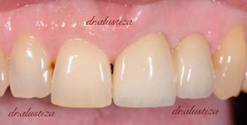 clinica dental bilbao alustiza implantes zirconio