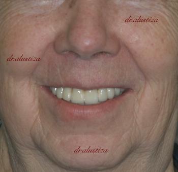 clinica dental alustiza bilbao implantes dentales resultado
