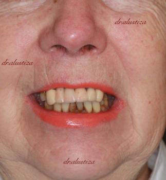 clinica dental alustiza bilbao implantes dentales