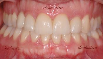 clinica dental alustiza bilbao desgaste dental despues