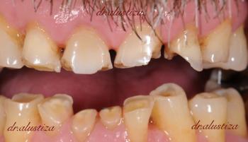 clinica dental alustiza bilbao protesis fija