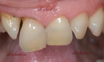 clinica dental alustiza bilbao puente de zirconio