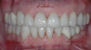clinica dental alustiza sustitución protesis antiguas