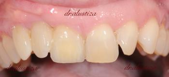 clinica dental alustiza bilbao implantes dentales resultado