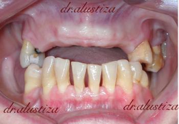 clinica dental bilbao alustiza extraccion e implantes