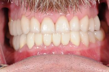 clinica dental alustiza bilbao reparación dental