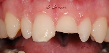 clinica dental alustiza bilbao carillas