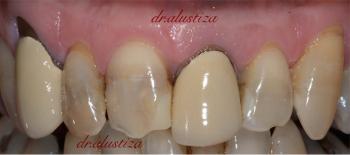 clinica dental alustiza bilbao cambio carillas