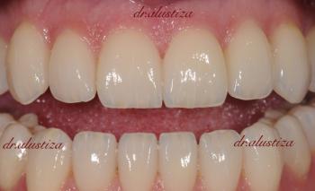 clinica dental alustiza bilbao carillas despues