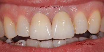 clinica dental alustiza bilbao coronas de ceramica completas