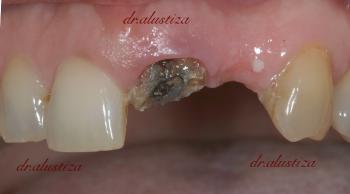 clinica dental bilbao alustiza coronas