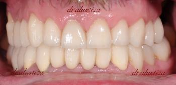 clinica dental alustiza bilbao reparación despues