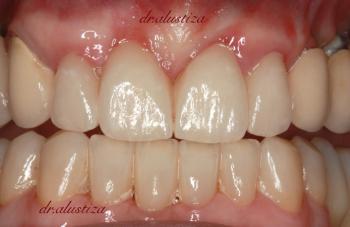 clinica dental bilbao alustiza reparación estetica