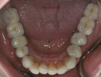 clinica dental alustiza bilbao estetica despues