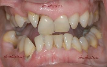 clinica dental alustiza bilbao implantes dentales