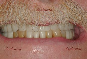 clinica dental bilbao alustiza implantes dentales
