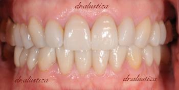 clinica dental alustiza bilbao desgaste dental despues