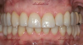 Clinica dental alustiza implantes dentales despues