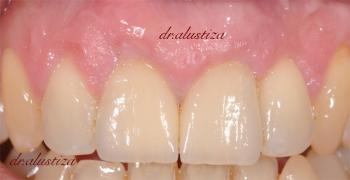 clinica dental alustiza bilbao protesis