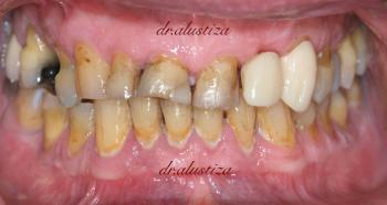 clinica dental alustiza bilbao carillas