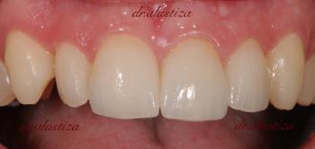 clinica dental alustiza bilbao estetica por traumatismo