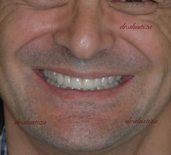 clinica dental bilbao alustiza estetica dental despues