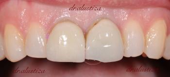 clinica dental alustiza bilbao coronas completas