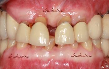 clinica dental alustiza bilbao cambio antes