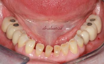 clinica dental alustiza bilbao desgaste acusado