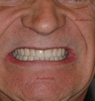 clinica dental alustiza desgaste acusado