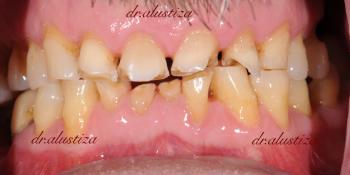 clinica dental alustiza desgaste dental