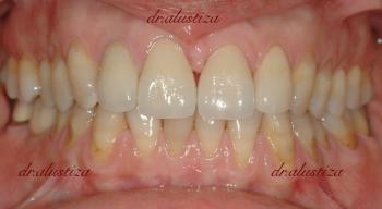 clinica dental bilbao alustiza reparación estetica