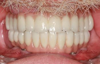 clinica dental bilbao alustiza reparación estetica
