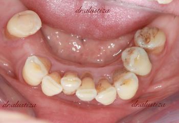 clinica dental alustiza bilbao fallo protesis anterior