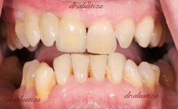 clinica dental alustiza bilbao injerto oseo