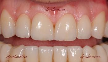 clinica dental alustiza ortodoncia despues