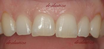 clinica dental alustiza bilbao margenes gingivales