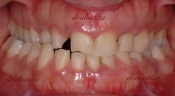 clinica dental alustiza bilbao desgaste dental