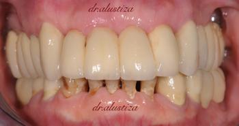 clinica dental bilbao alustiza traumatismo despues