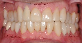 clinica dental alustiza rehabilitacion completa