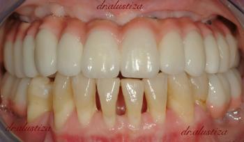 clinica dental bilbao alustiza implantes molares