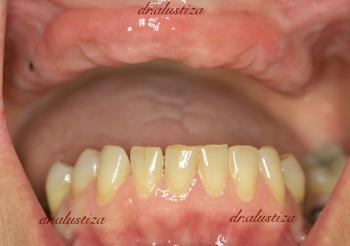 clinica dental bilbao alustiza implantes