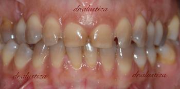 clinica dental alustiza estetica antes